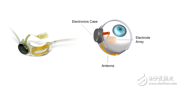 Argus II仿生眼，帮助盲人重见光明!